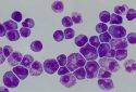 Researchers identify therapeutic target for acute promyelocytic leukemia