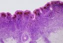 Congenital melanocytic nevus