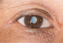 Cataract in the eye lens.