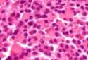 Micrograph of a plasmacytoma. (multiple myeloma).