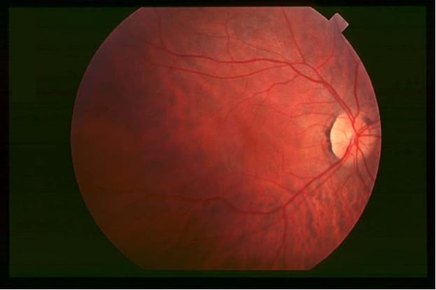 New hope for retinitis pigmentosa therapy