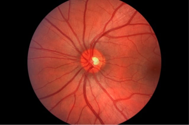 Human retina, optic nerve.
