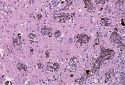 New insights into melanoma brain metastases