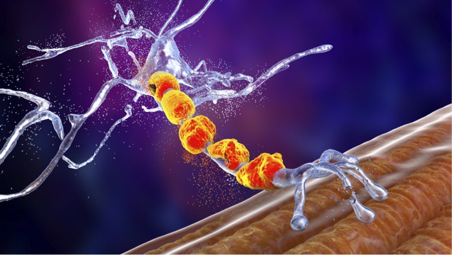 Motor neuron degeneration illustration.