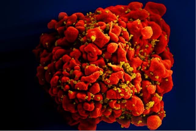 HIV speeds up biological aging soon after infection