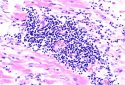Histopathological image of viral myocarditis.