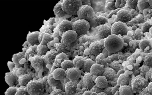 A scanning electron micrograph depicts a clump of prostate cancer cells.