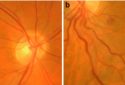 Artificial intelligence-enabled imaging of the retina’s vasculature can predict cardiovascular disease and mortality