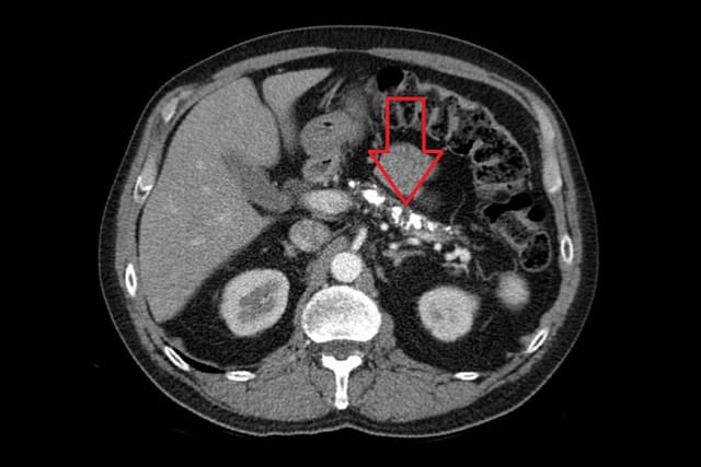 Axial CT showing multiple calcifications in the pancreas in a patient with chronic pancreatitis.