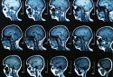 MRI reveals significant brain abnormalities post-COVID-19