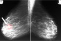 Mammogram showing breast cancer tumor.