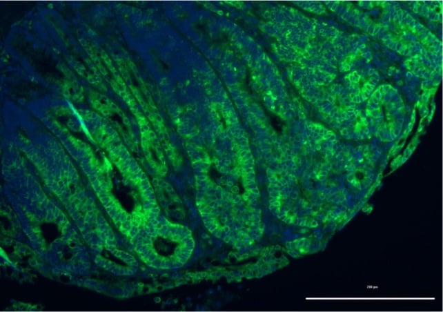 Green staining shows mTORC1 is significantly increased due to disruption in GATOR1 in a mouse model of colon cancer.