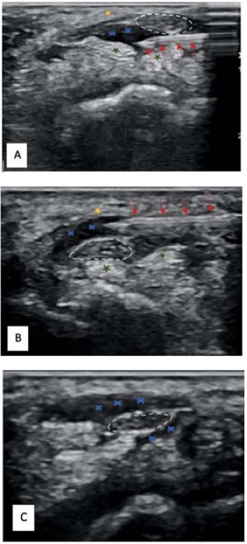 Ultrasound images depicting hydrodissection procedure in a patient with carpal tunnel syndrome.
