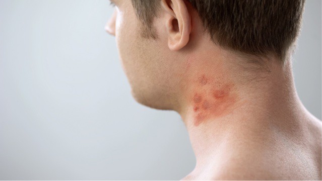 Male patient with atopic dermatitis.