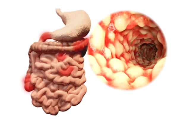 Antibody-producing B cells can prevent intestinal healing