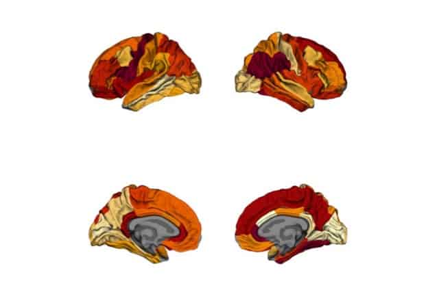Obesity-related neurodegeneration mimics Alzheimer’s disease