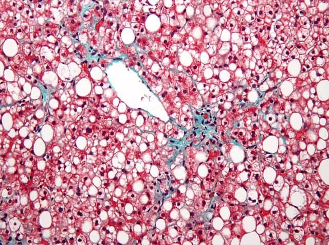 Micrograph of non-alcoholic fatty liver disease (NAFLD).