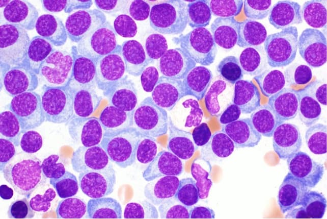 Multiple myeloma cells