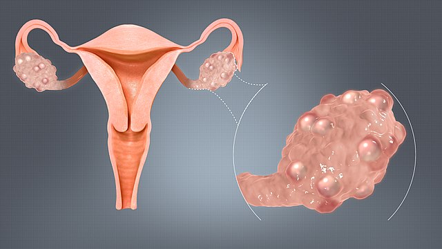Polycystic ovary syndrome (PCOS) illustration.