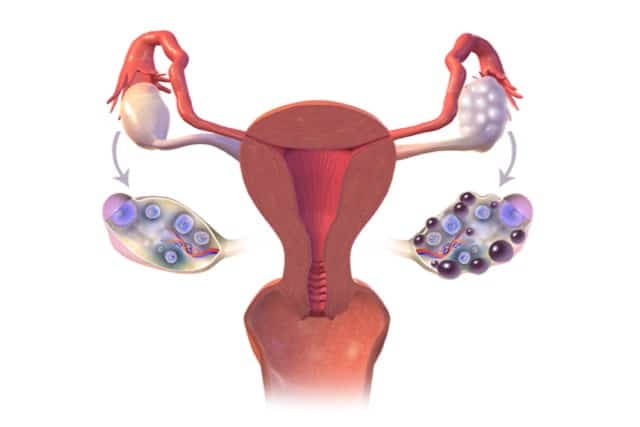 A medical illustration depicting polycystic ovary syndrome (PCOS).