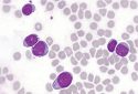 T-lymphoblastic cells of acute leukemia in the bone marrow.