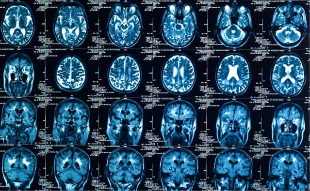 CT scan of human brain.