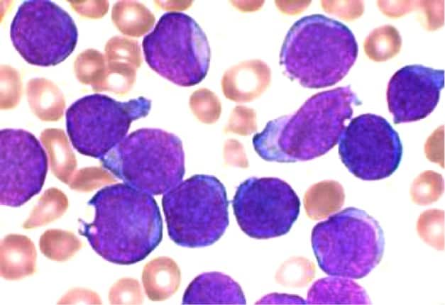 B-cell acute lymphoblastic leukemia - bone marrow aspirate
