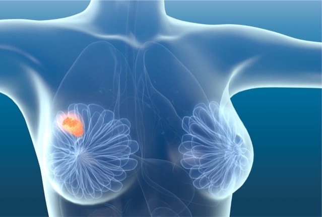 Breast cancer illustration.