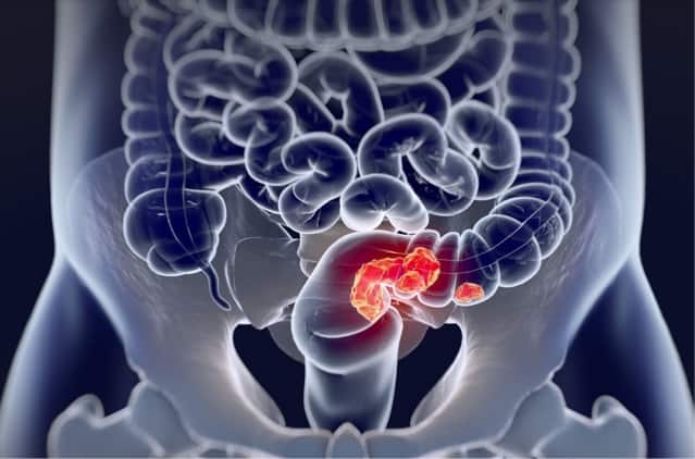 Research breakthrough sparks new hope for colorectal cancer patients
