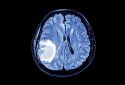 Brain MRI showing presence of tumor.
