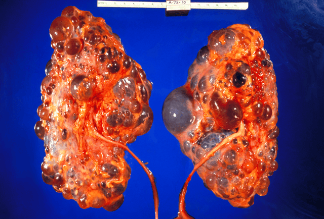 Gross pathologic changes in a case of polycystic kidney disease.