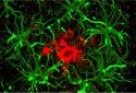 Brain astrocytes attracted by an amyloid plaque.