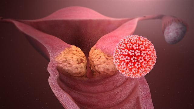 HPV causing cervical cancer.