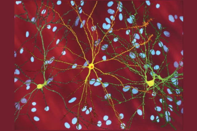 Neuron with mHtt inclusion.