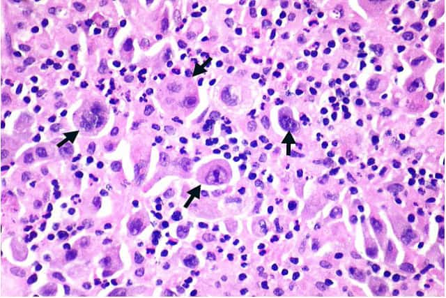 Poorly differentiated non-small cell carcinoma NOS with a massive host inflammatory response.