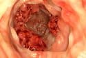 Colon cancer illustration.