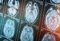 Computed tomography of brain, brain x-rays.