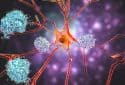 Neuron and amyloid plaques, illustration.