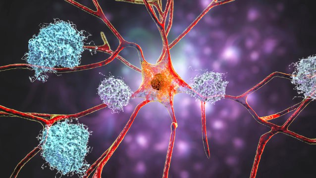 Neuron and amyloid plaques, illustration.