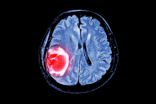MRI brain scan showing brain tumor.