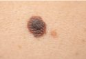 Dangerous nevus on skin, melanoma, skin cancer.