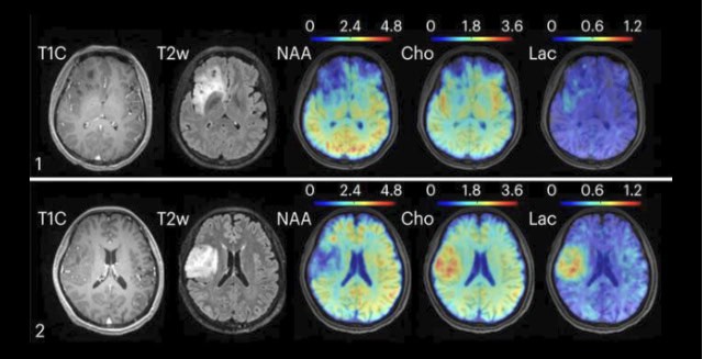 Brain metabolic imaging, brain metabolic MRI.