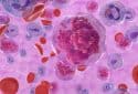 Acute lymphoblastic leukemia (ALL) cancer cells in the blood.