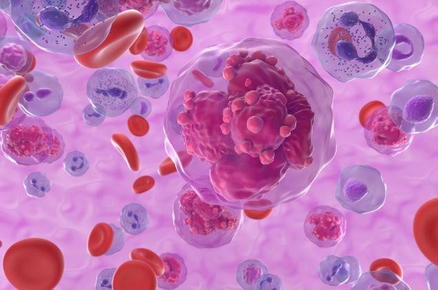 Acute lymphoblastic leukemia (ALL) cancer cells in the blood.