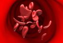 Sickle cell disease, illustration.