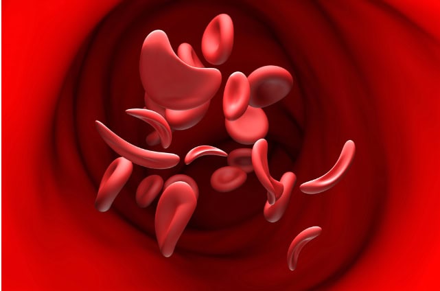 Sickle cell disease, illustration.