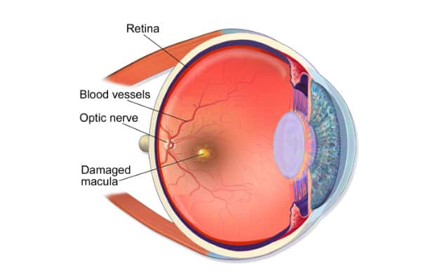 A medical illustration depicting macular degeneration.degeneration.