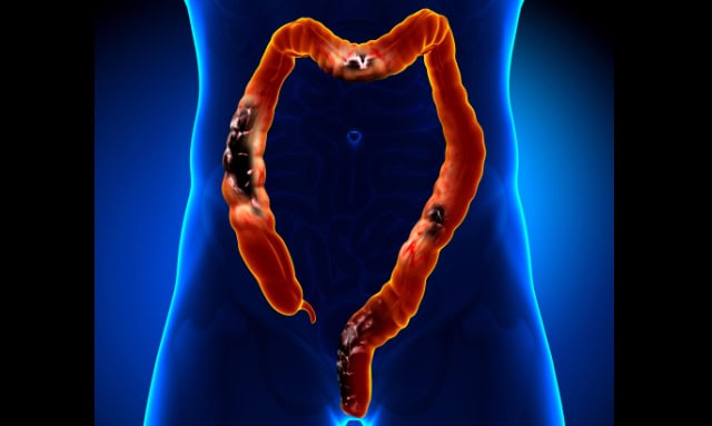 Colorectal cancer illustration.