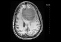 An MRI scan of a large meningioma tumor.
