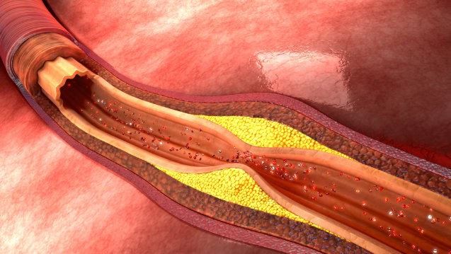 Arterial plaque, atherosclerosis, illustration.